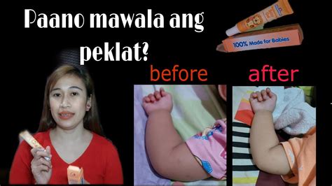 MABISANG PANTANGGAL NG PEKLAT NI BABY .